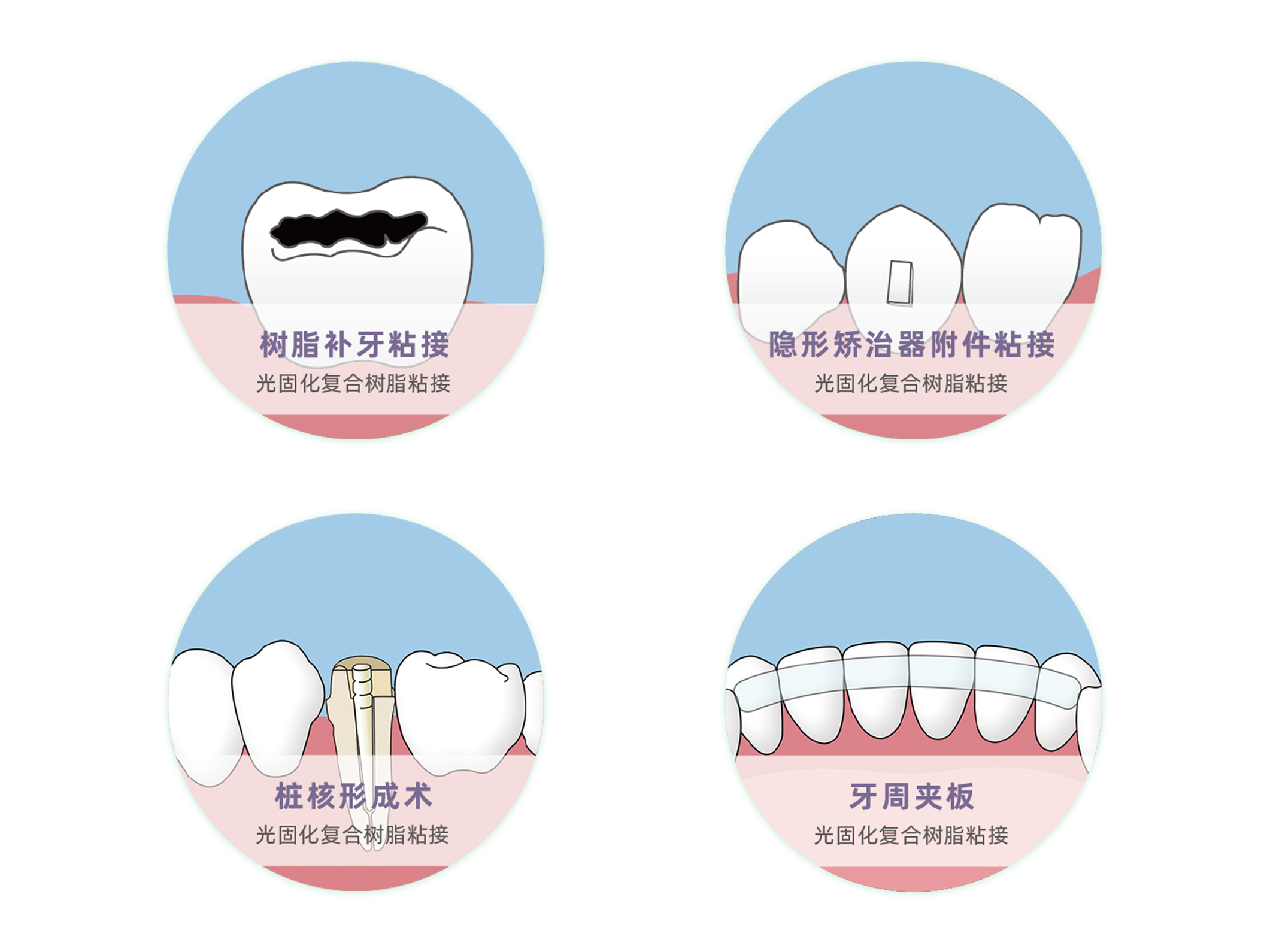 通用型补的牢的沪鸽美天固光固化复合树脂