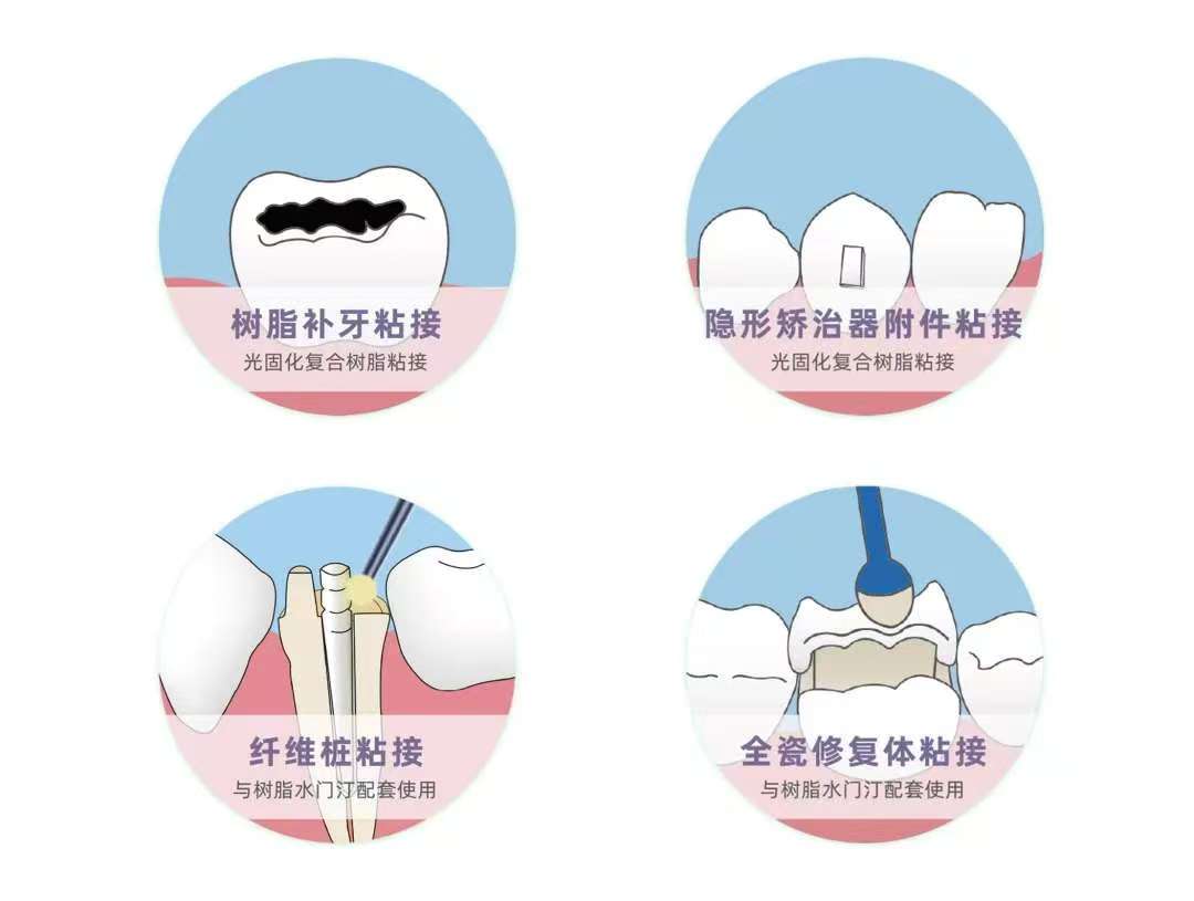 美益汀 光固化牙体粘接剂