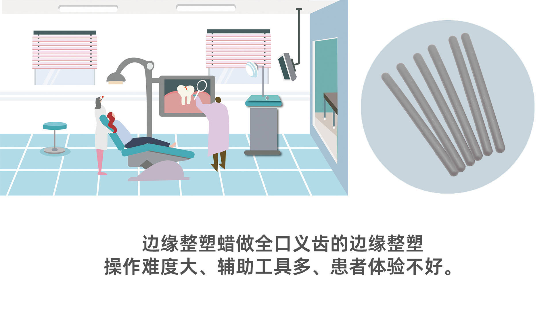 用美佳印枪混1型做全口义齿边缘整塑：一次成型，操作更便捷！