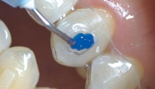 沪鸽美益汀光固化牙体粘接剂 | 用于隐形矫治器附件的操作流程