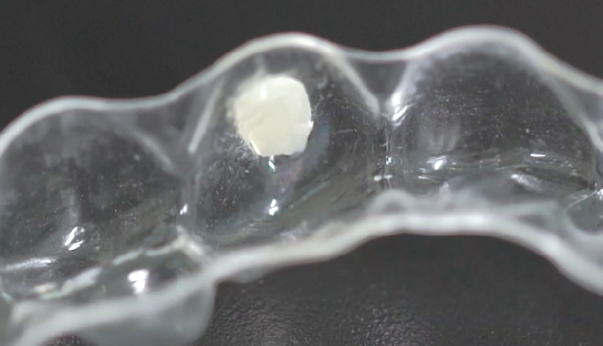 沪鸽美益汀光固化牙体粘接剂 | 用于隐形矫治器附件的操作流程