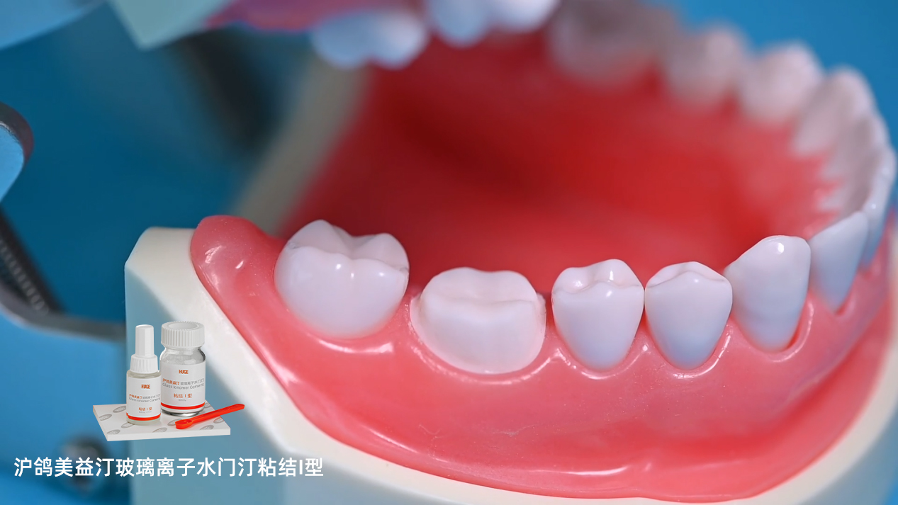 沪鸽美益汀玻璃离子水门汀粘结I型 | 用于烤瓷牙粘结操作流程