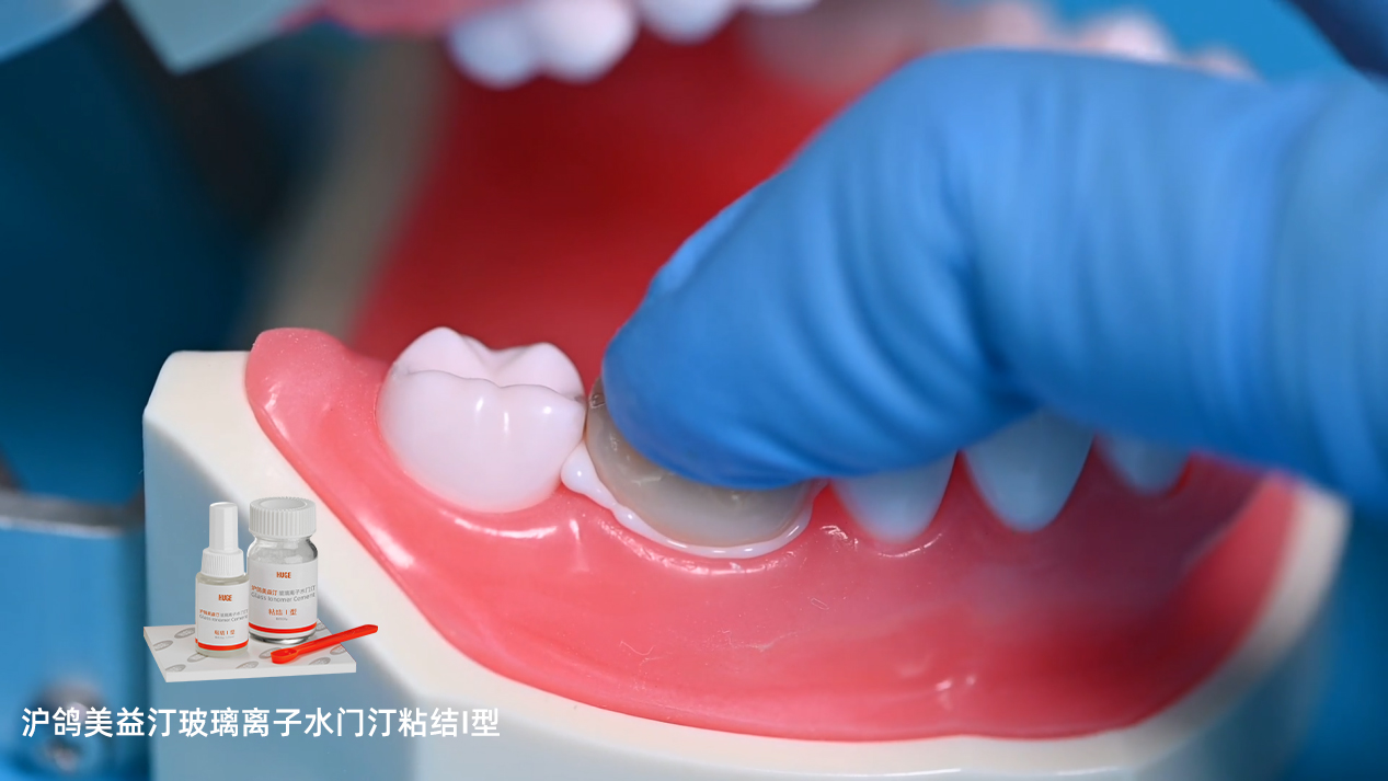 沪鸽美益汀玻璃离子水门汀粘结I型 | 用于烤瓷牙粘结操作流程