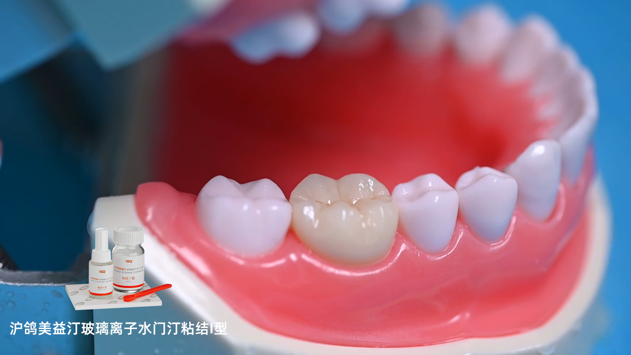 沪鸽美益汀玻璃离子水门汀粘结I型 | 用于烤瓷牙粘结操作流程