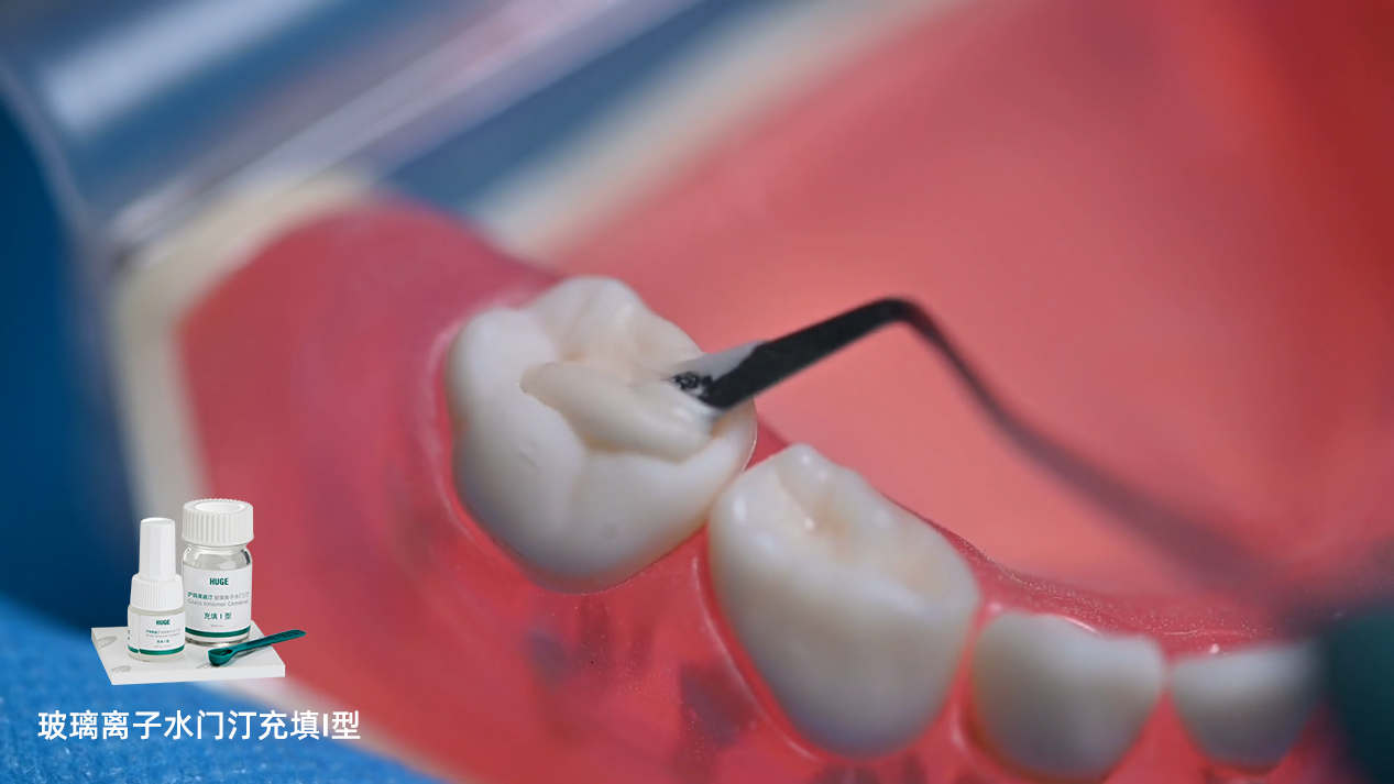 沪鸽美益汀玻璃离子水门汀充填I型 | 用于乳牙充填操作流程