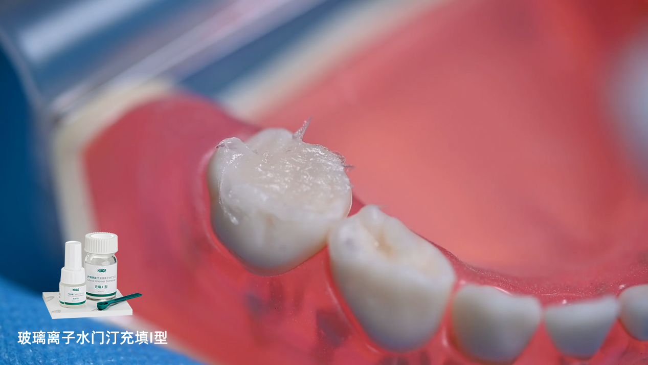 沪鸽美益汀玻璃离子水门汀充填I型 | 用于乳牙充填操作流程