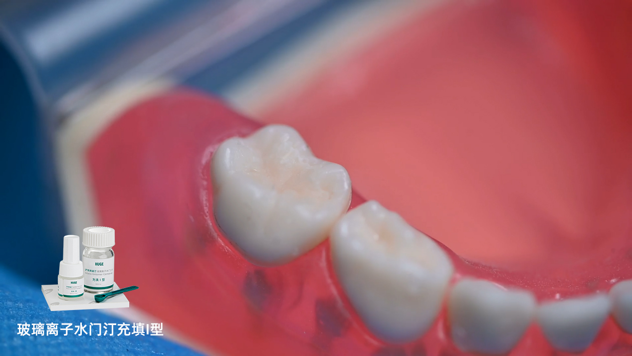 沪鸽美益汀玻璃离子水门汀充填I型 | 用于乳牙充填操作流程