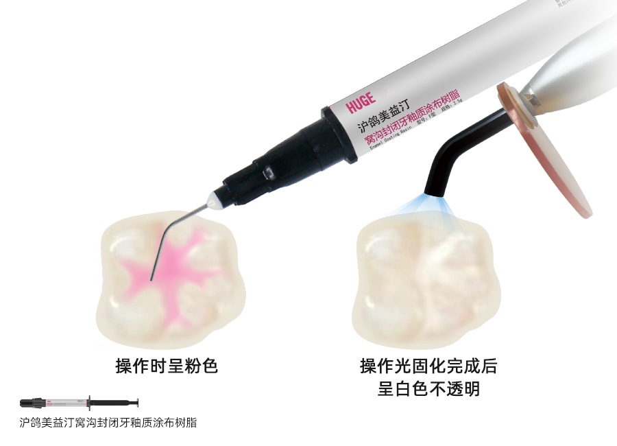 沪鸽美益汀窝沟封闭牙釉质涂布树脂，会变色的窝沟封闭